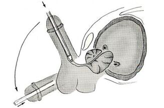 Endoscopic penis enlargement surgery plan